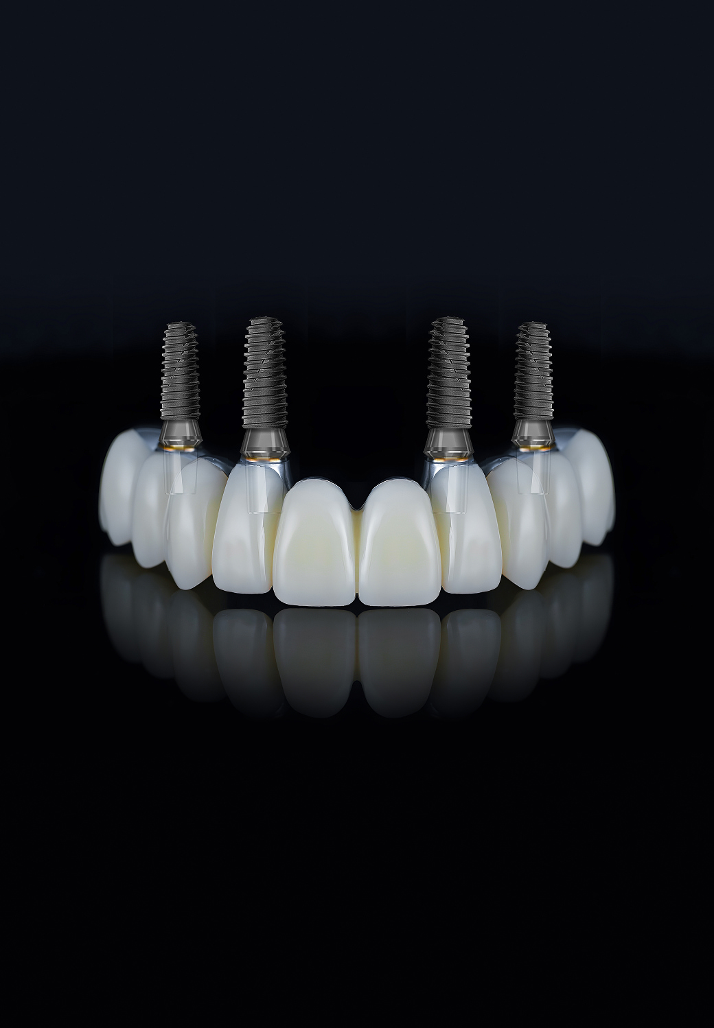 All-On-4-Full-Arch-Implants Banner Image