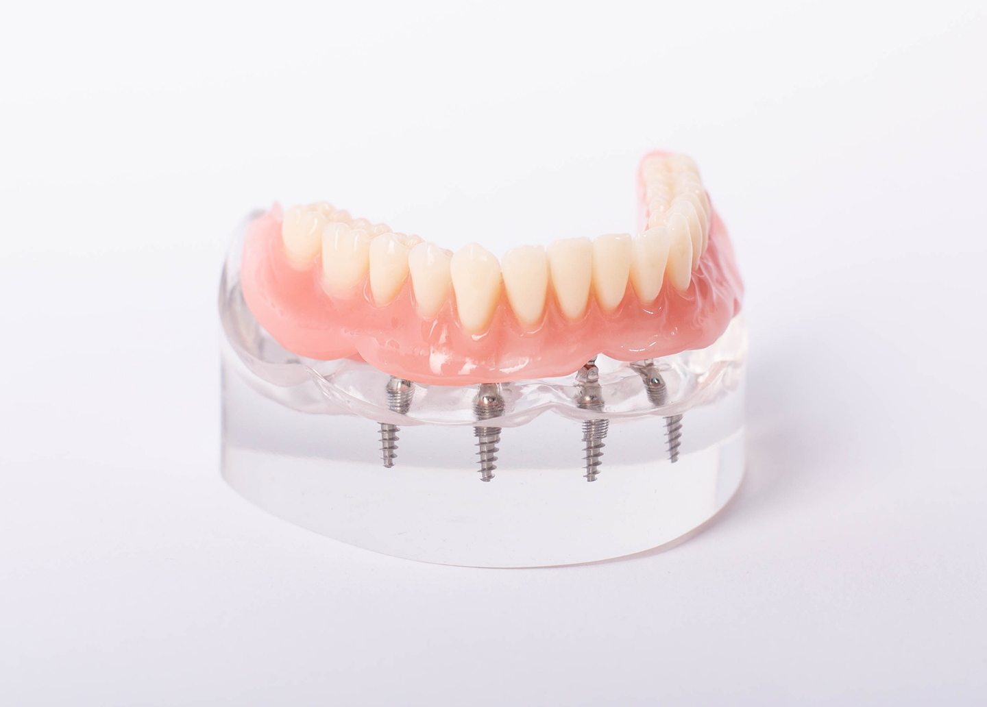 Candidates for All-on-4 dental implants and full arch restoration