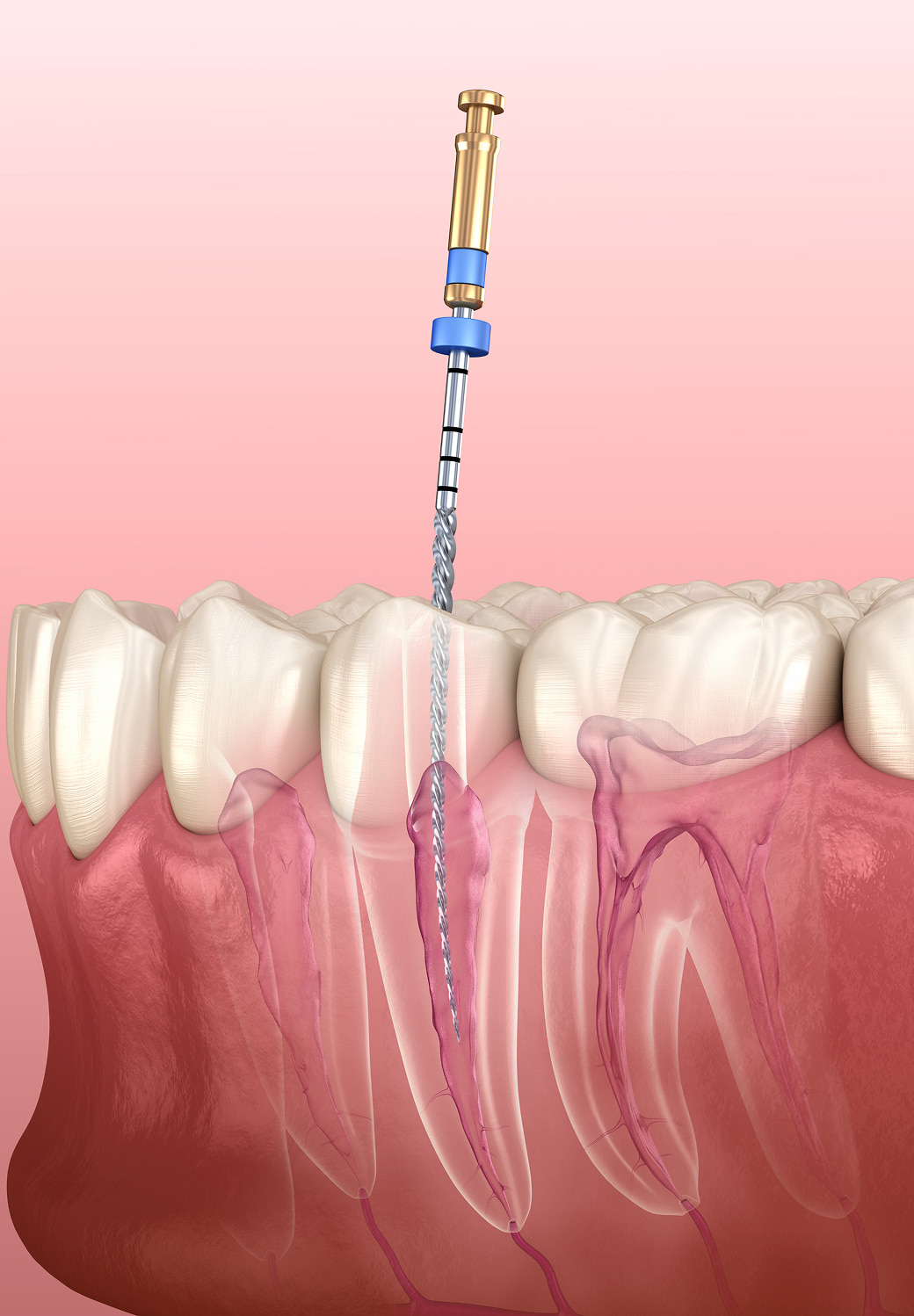 Root Canal Therapy Banner Image