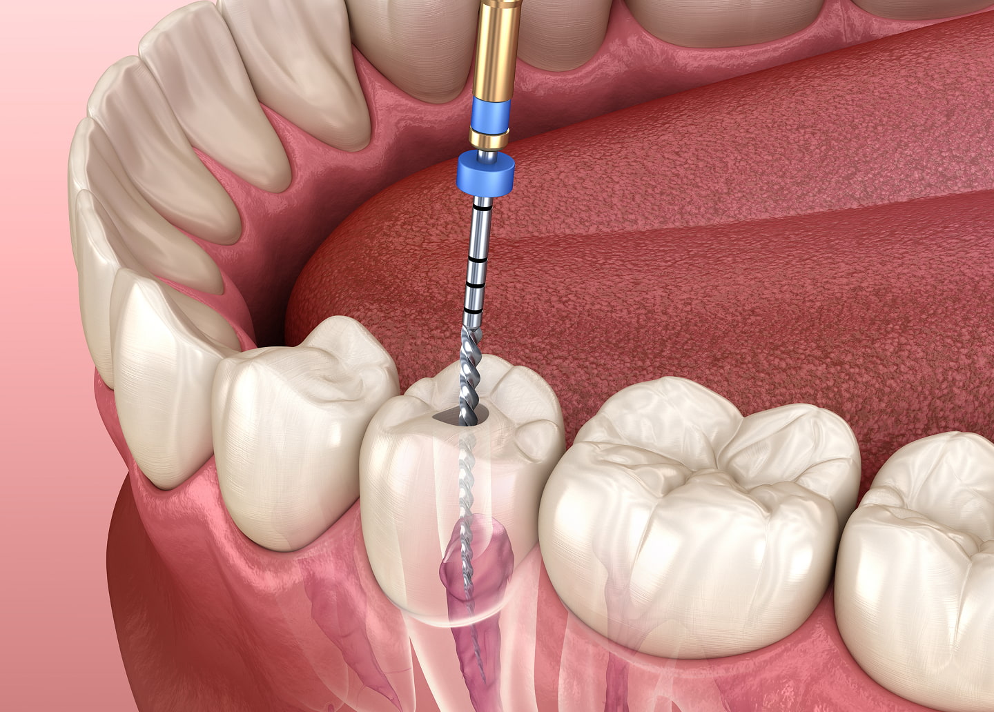 Aftercare tips for root canal recovery including pain management, oral hygiene, and follow-up care