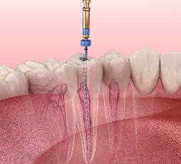 Dental Sealants