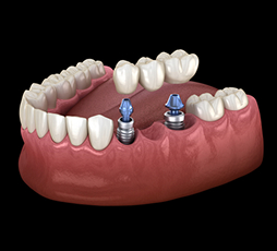 Implant Supported Bridges