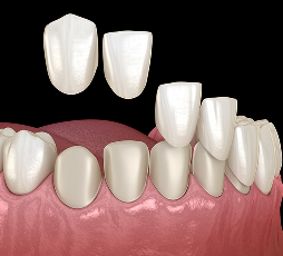 Porcelain Veneers